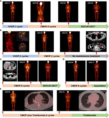 Case report: Good response to CMOP regimen containing mitoxantrone hydrochloride liposome (PLM60) as induction chemotherapy in patients with angioimmunoblastic T-cell lymphoma